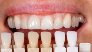 color de carillas dentales