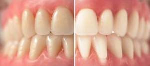 manchas en los dientes por tetraciclinas