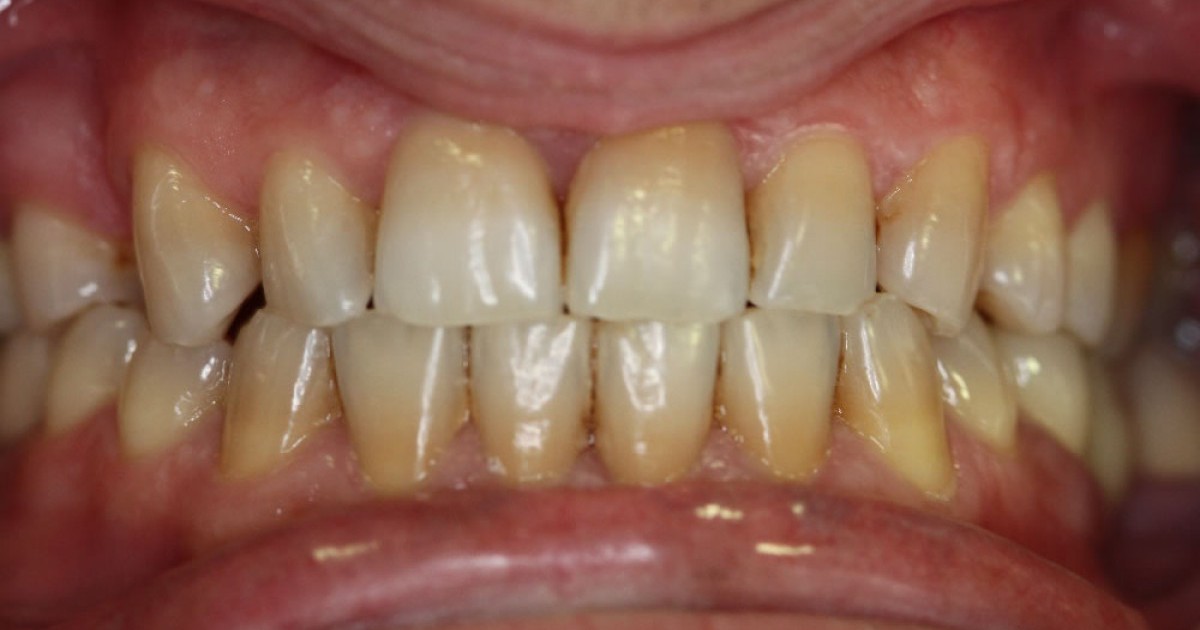manchas en los dientes por tetraciclinas