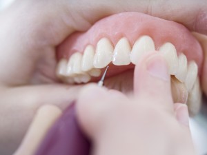 incrustaciones dentales